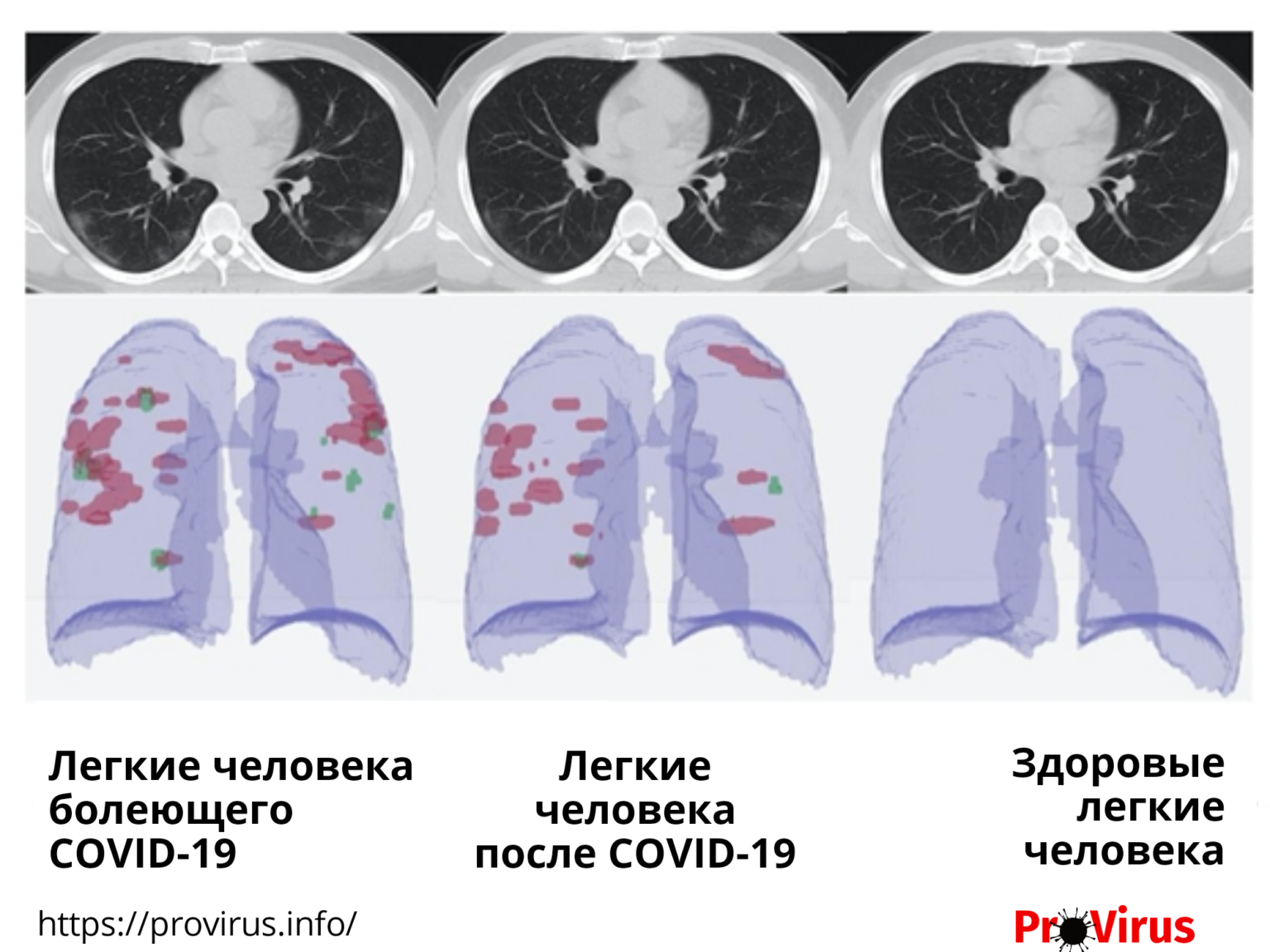Легкие восстановятся после коронавируса. Легкие после Ковида на кт. Поражение легких при коронавирусе. Пневмония на кт. Лёгкие при коронавирусе.